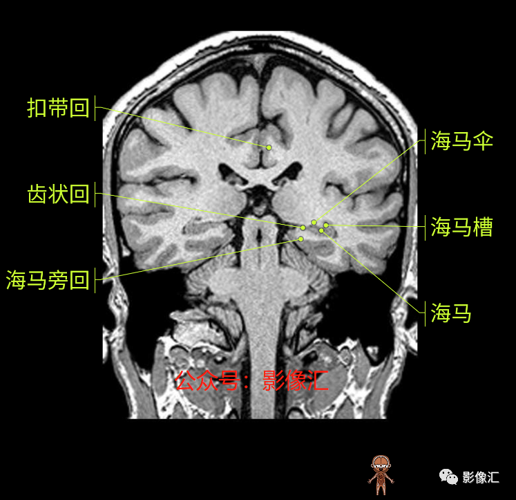 影像PPT - 脑边缘叶MR解剖标记-139