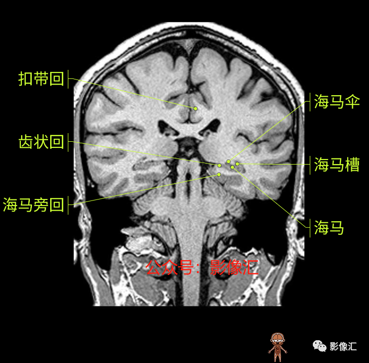 影像PPT - 脑边缘叶MR解剖标记-140