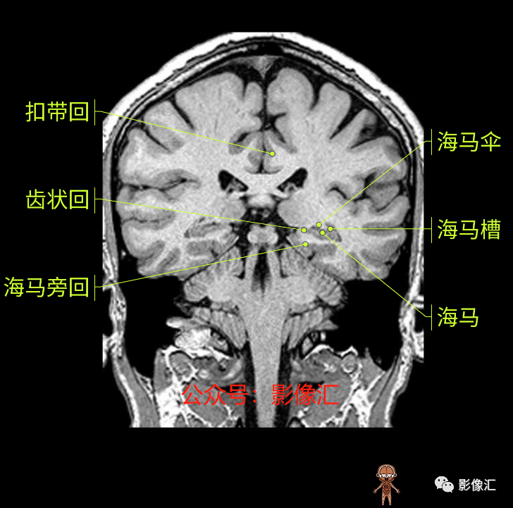 影像PPT - 脑边缘叶MR解剖标记-141