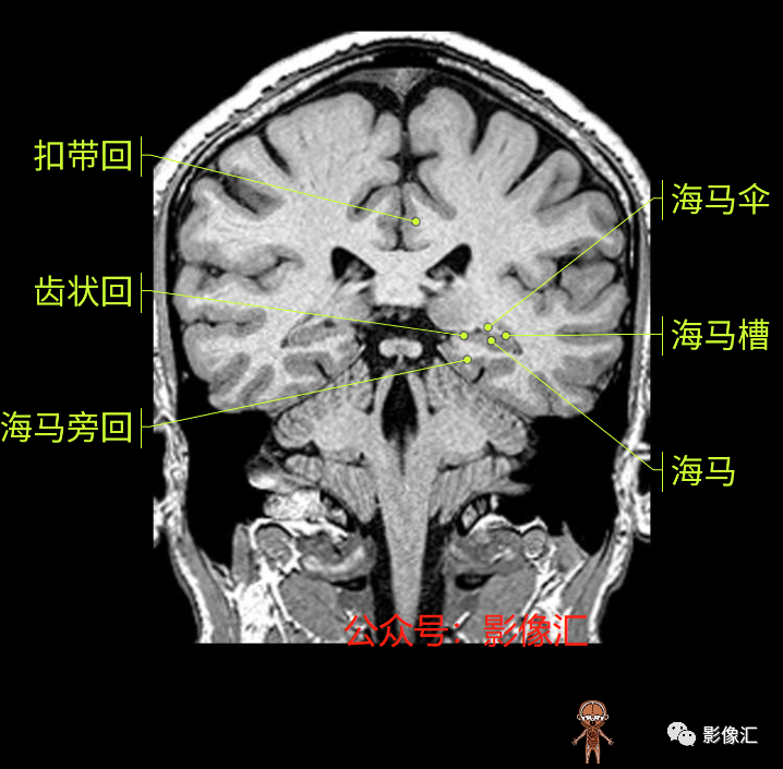 影像PPT - 脑边缘叶MR解剖标记-142