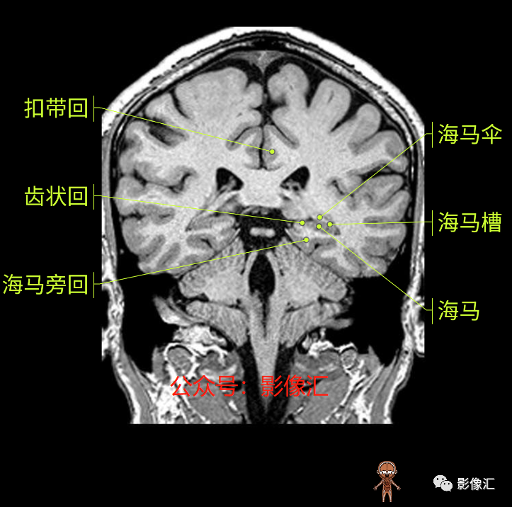 影像PPT - 脑边缘叶MR解剖标记-143