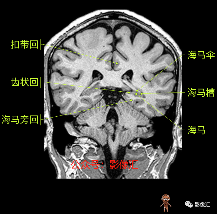 影像PPT - 脑边缘叶MR解剖标记-144