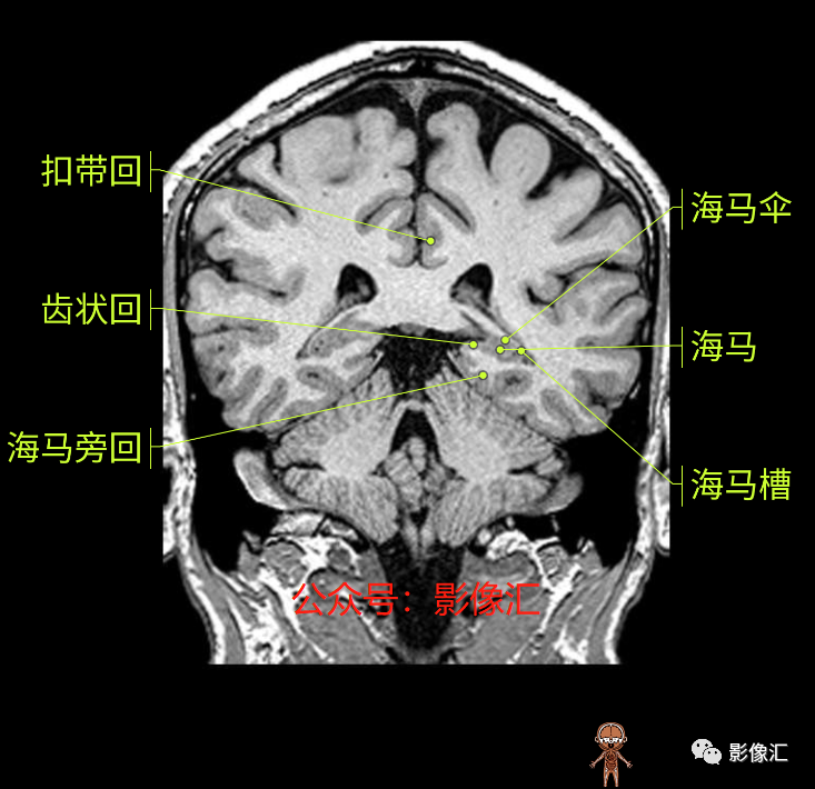 影像PPT - 脑边缘叶MR解剖标记-145