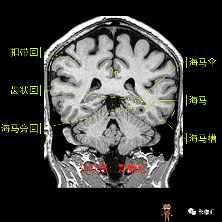 影像PPT - 脑边缘叶MR解剖标记-146
