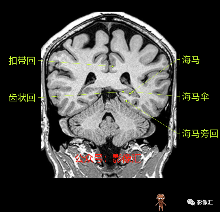 影像PPT - 脑边缘叶MR解剖标记-147