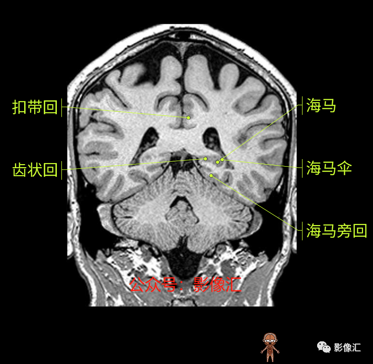 影像PPT - 脑边缘叶MR解剖标记-148