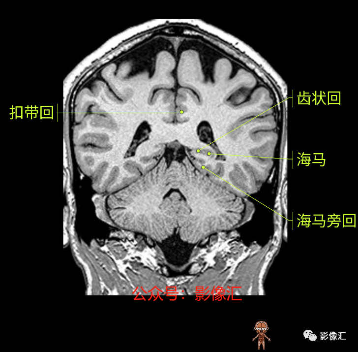 影像PPT - 脑边缘叶MR解剖标记-149