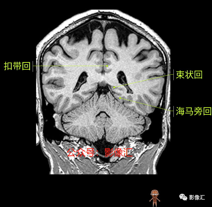 影像PPT - 脑边缘叶MR解剖标记-150