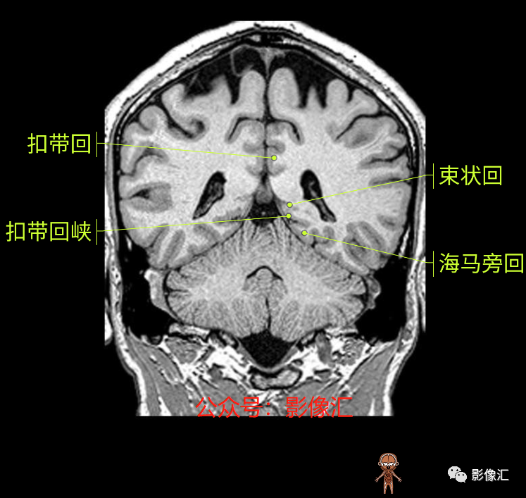 影像PPT - 脑边缘叶MR解剖标记-151
