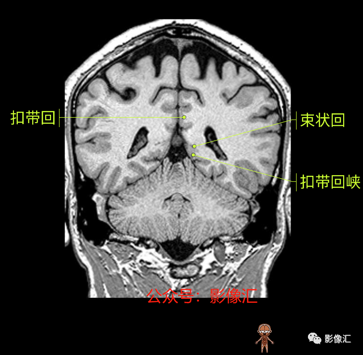 影像PPT - 脑边缘叶MR解剖标记-152
