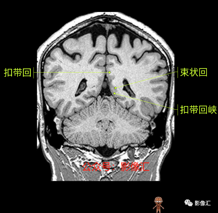 影像PPT - 脑边缘叶MR解剖标记-153