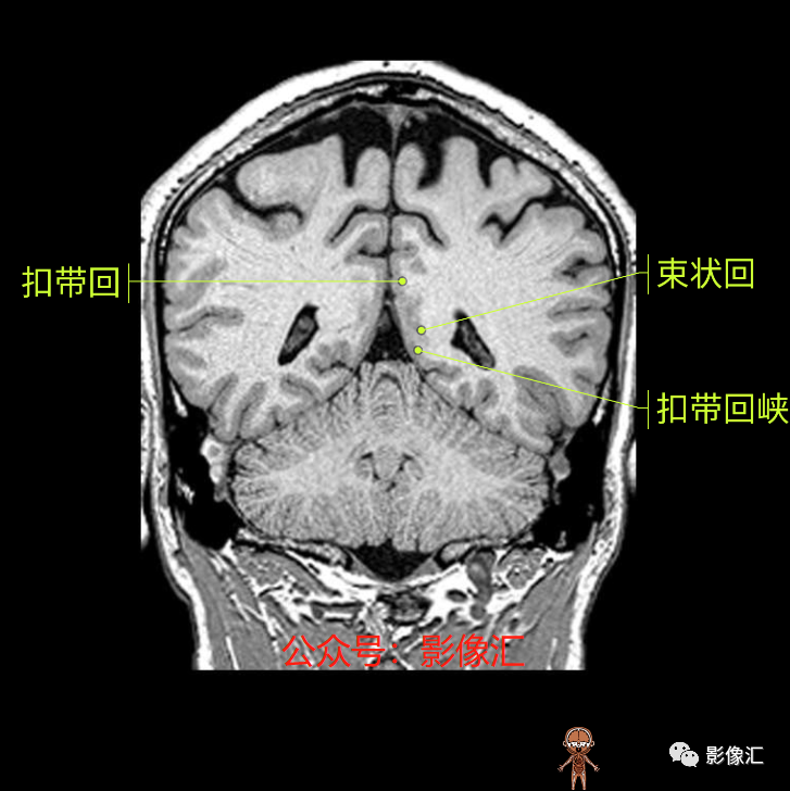 影像PPT - 脑边缘叶MR解剖标记-154