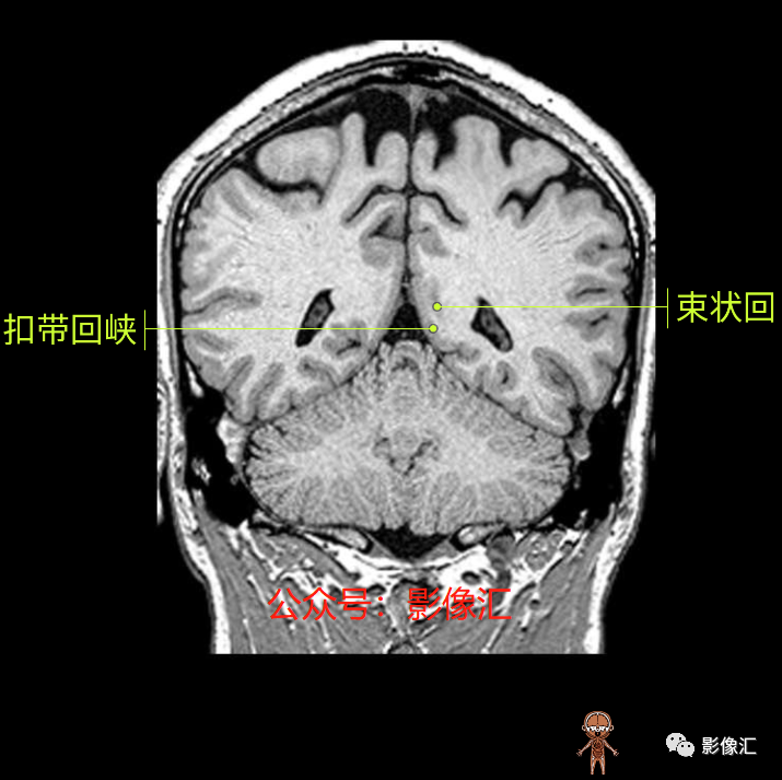 影像PPT - 脑边缘叶MR解剖标记-155