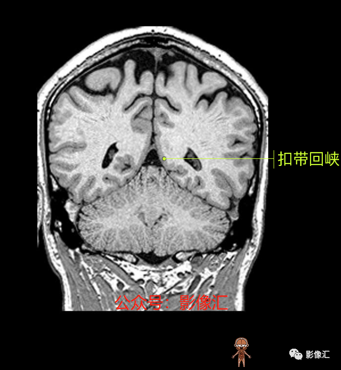 影像PPT - 脑边缘叶MR解剖标记-156