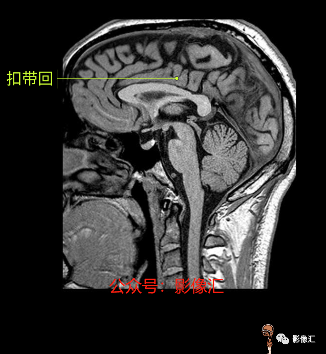 影像PPT - 脑边缘叶MR解剖标记-158