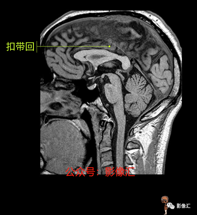 影像PPT - 脑边缘叶MR解剖标记-159