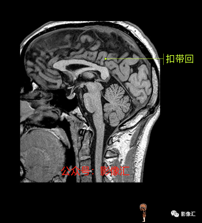 影像PPT - 脑边缘叶MR解剖标记-160