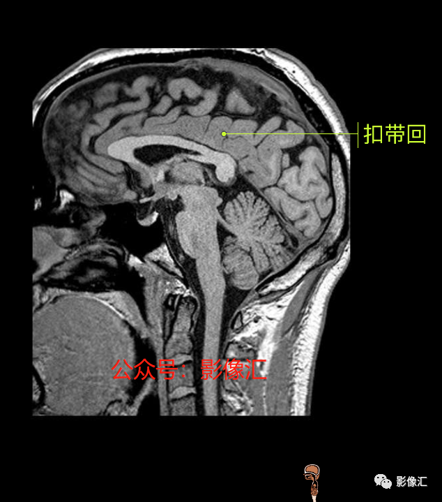 影像PPT - 脑边缘叶MR解剖标记-161