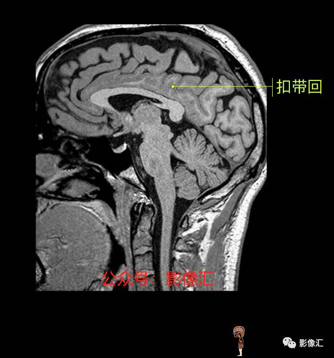 影像PPT - 脑边缘叶MR解剖标记-162