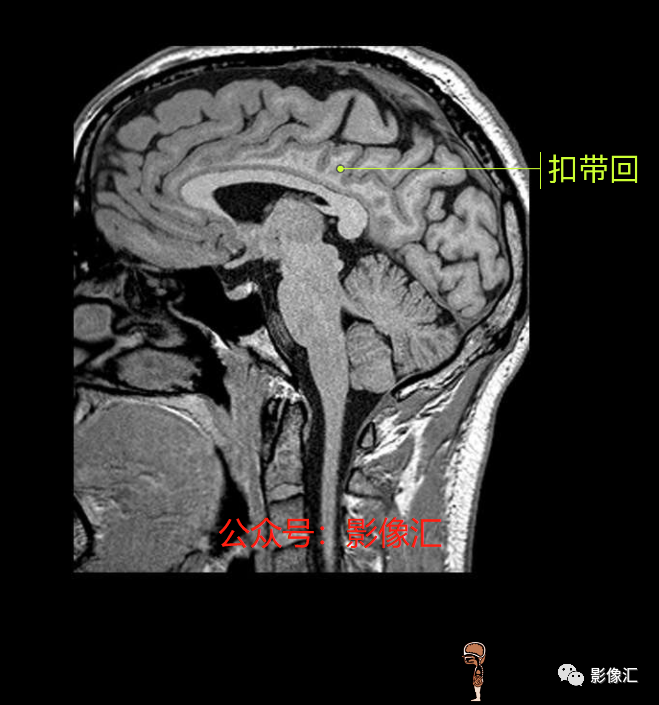影像PPT - 脑边缘叶MR解剖标记-163