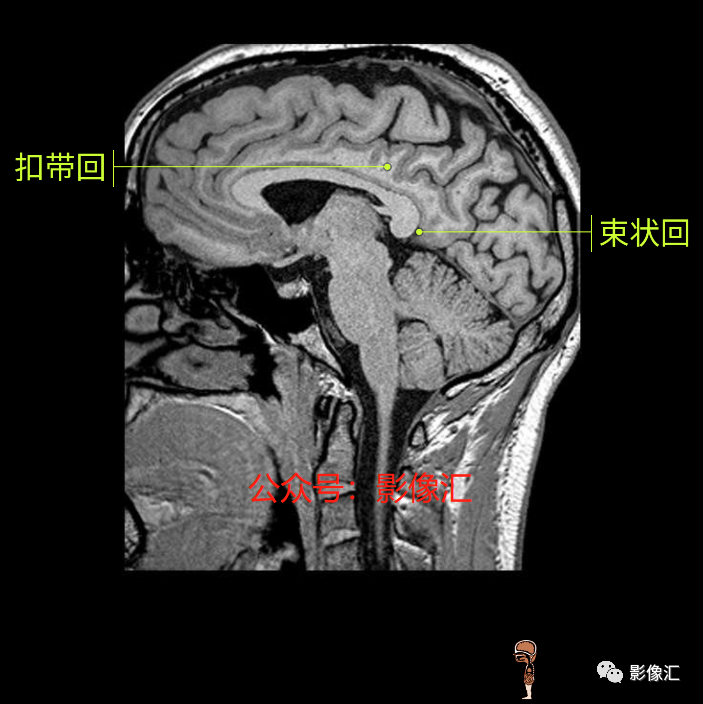 影像PPT - 脑边缘叶MR解剖标记-164