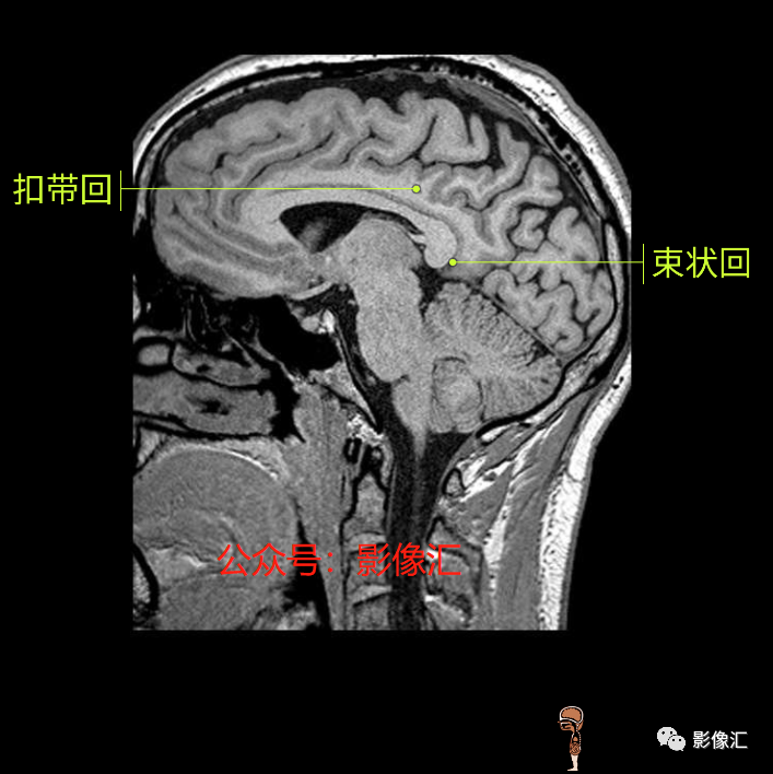 影像PPT - 脑边缘叶MR解剖标记-165