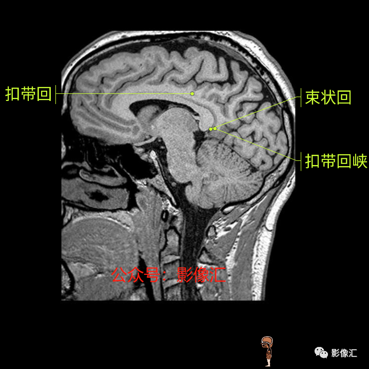 影像PPT - 脑边缘叶MR解剖标记-166