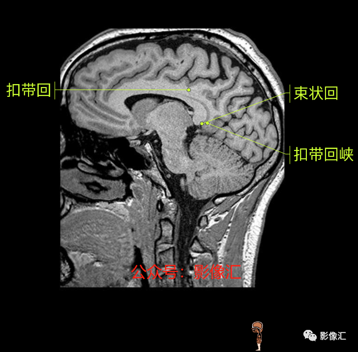 影像PPT - 脑边缘叶MR解剖标记-167