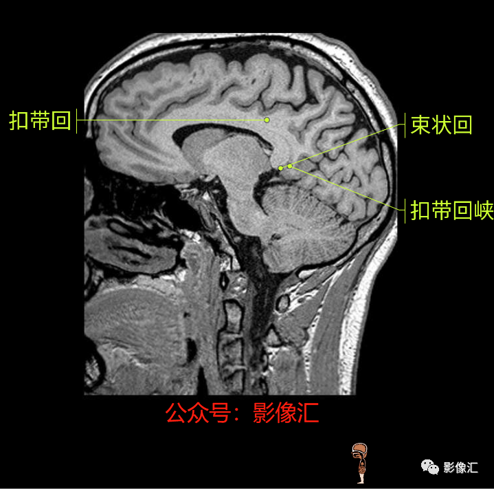 影像PPT - 脑边缘叶MR解剖标记-168