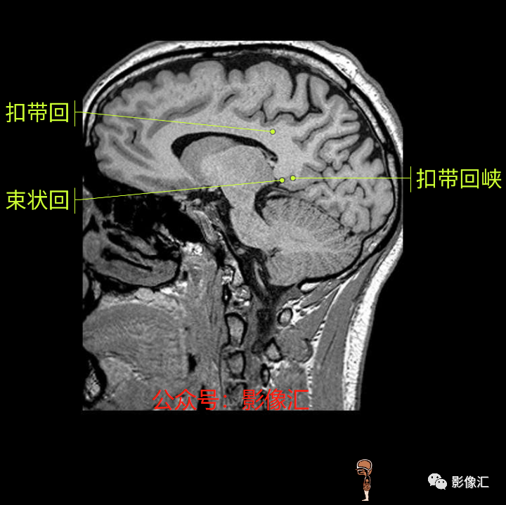 影像PPT - 脑边缘叶MR解剖标记-169