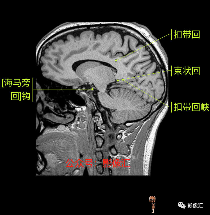 影像PPT - 脑边缘叶MR解剖标记-170