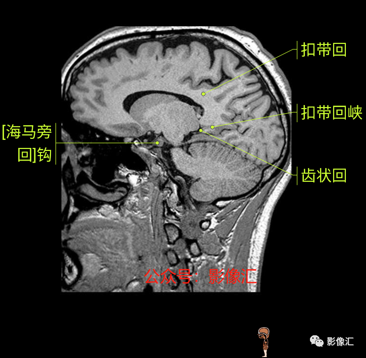 影像PPT - 脑边缘叶MR解剖标记-171