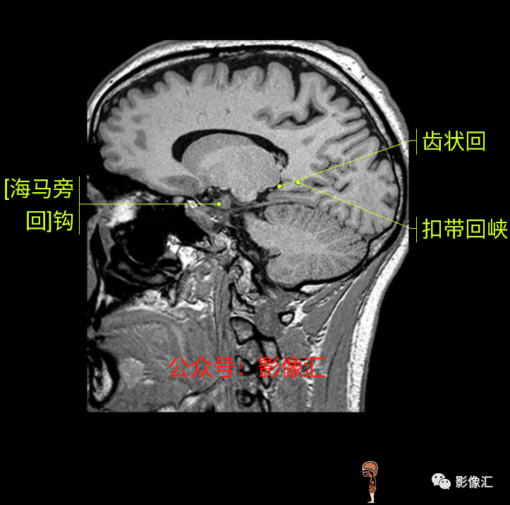 影像PPT - 脑边缘叶MR解剖标记-172