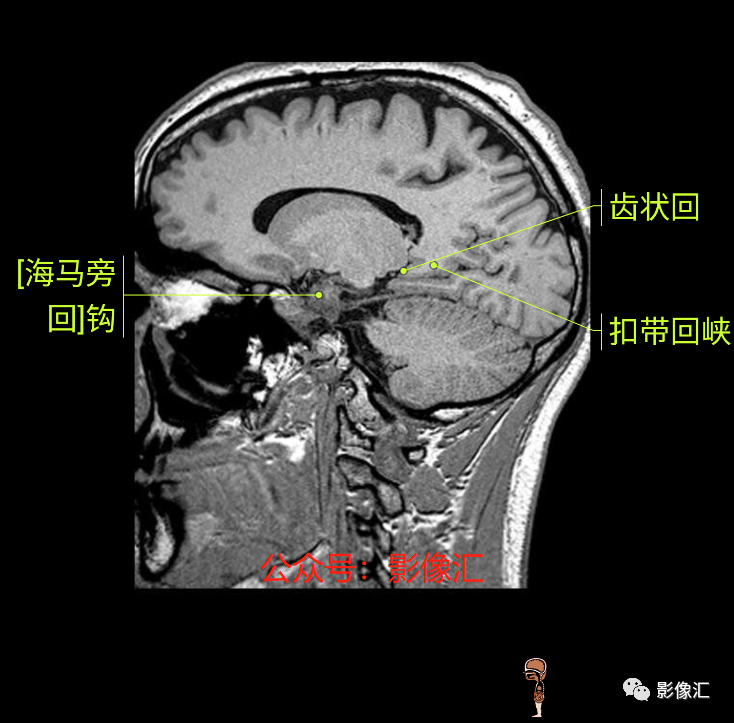 影像PPT - 脑边缘叶MR解剖标记-173