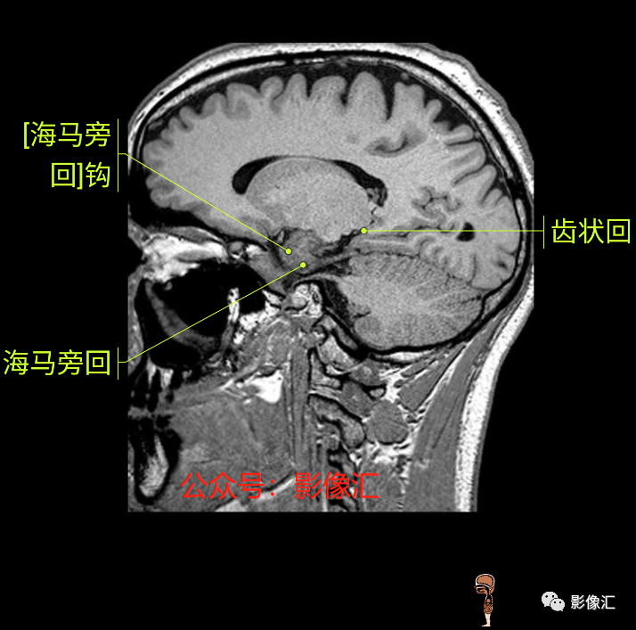影像PPT - 脑边缘叶MR解剖标记-174
