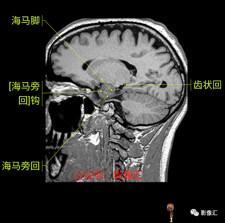 影像PPT - 脑边缘叶MR解剖标记-175