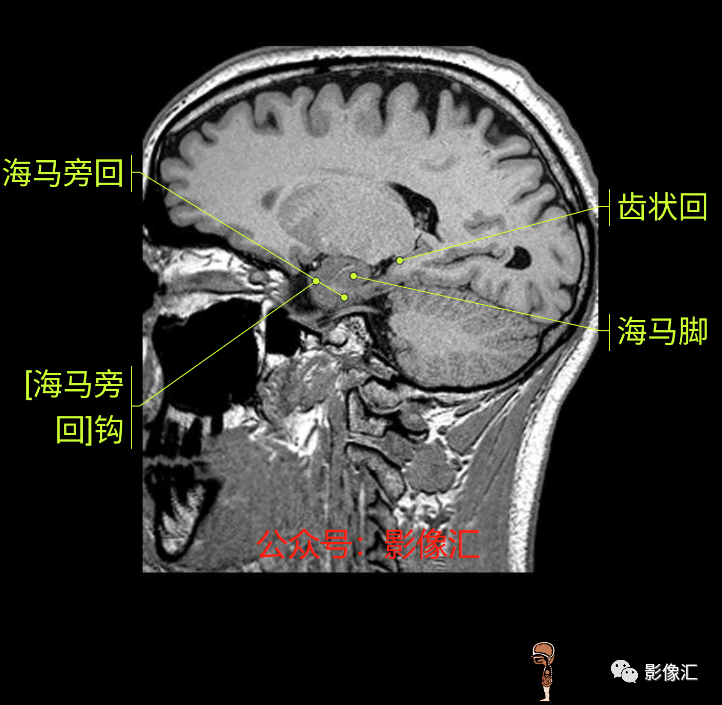 影像PPT - 脑边缘叶MR解剖标记-176