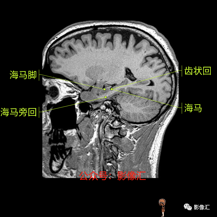 影像PPT - 脑边缘叶MR解剖标记-180
