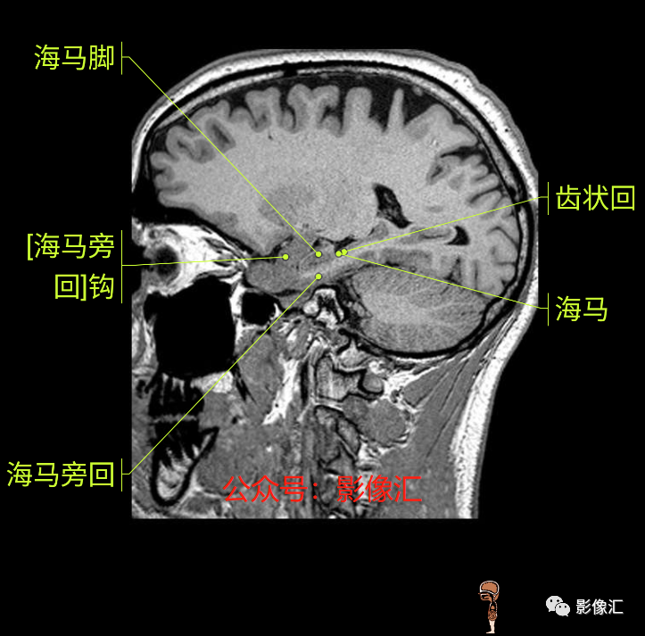 影像PPT - 脑边缘叶MR解剖标记-179