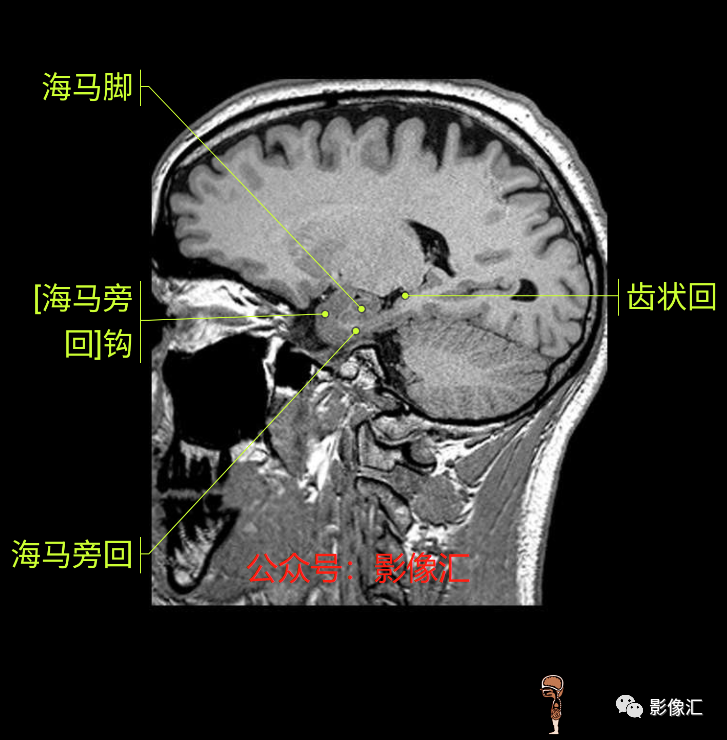 影像PPT - 脑边缘叶MR解剖标记-177