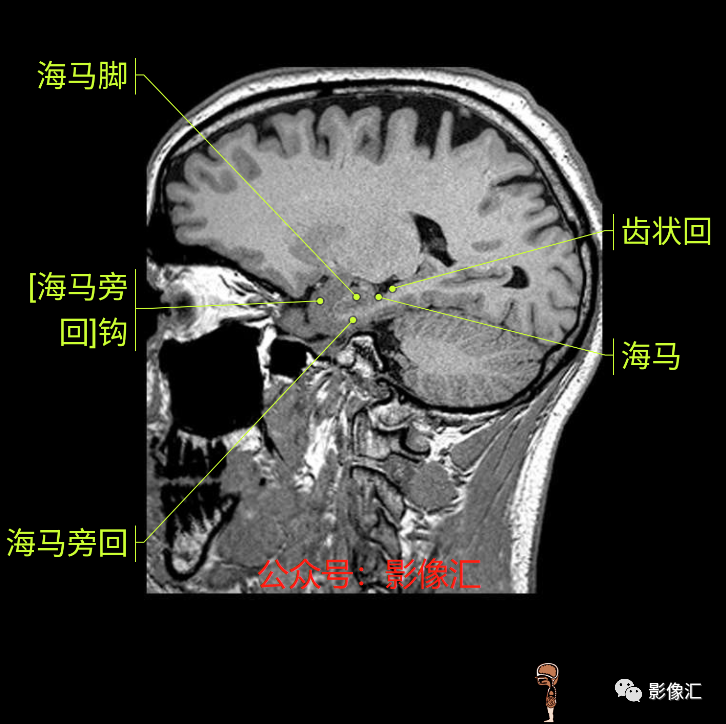 影像PPT - 脑边缘叶MR解剖标记-178
