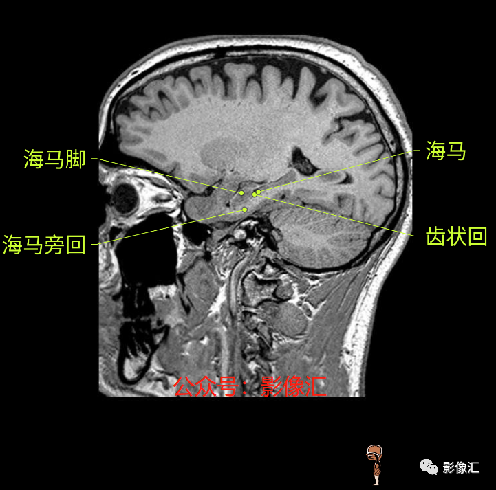 影像PPT - 脑边缘叶MR解剖标记-181