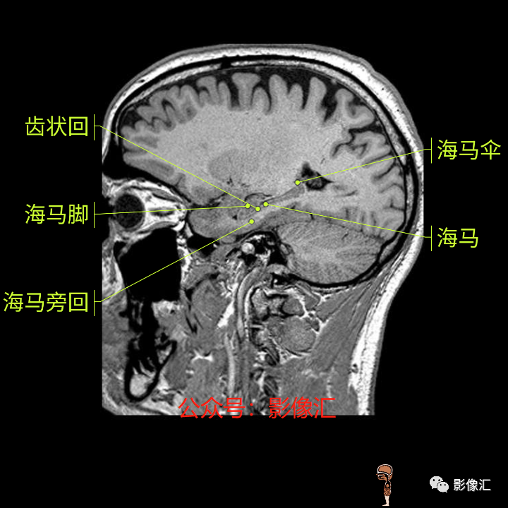 影像PPT - 脑边缘叶MR解剖标记-182