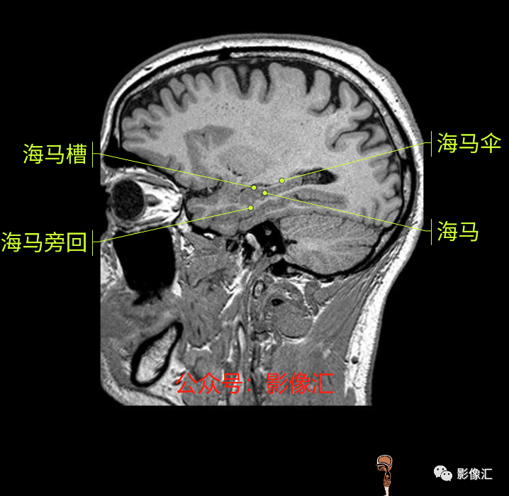 影像PPT - 脑边缘叶MR解剖标记-185