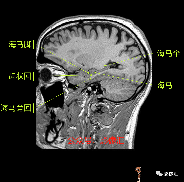影像PPT - 脑边缘叶MR解剖标记-183