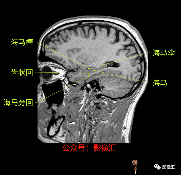 影像PPT - 脑边缘叶MR解剖标记-184