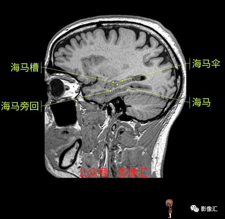 影像PPT - 脑边缘叶MR解剖标记-186