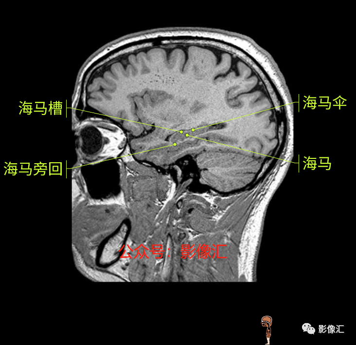 影像PPT - 脑边缘叶MR解剖标记-187
