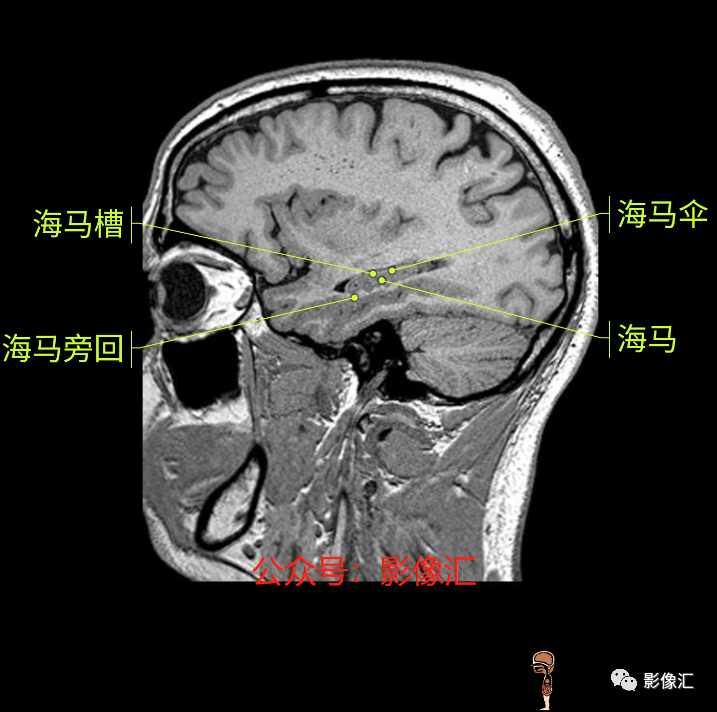 影像PPT - 脑边缘叶MR解剖标记-188