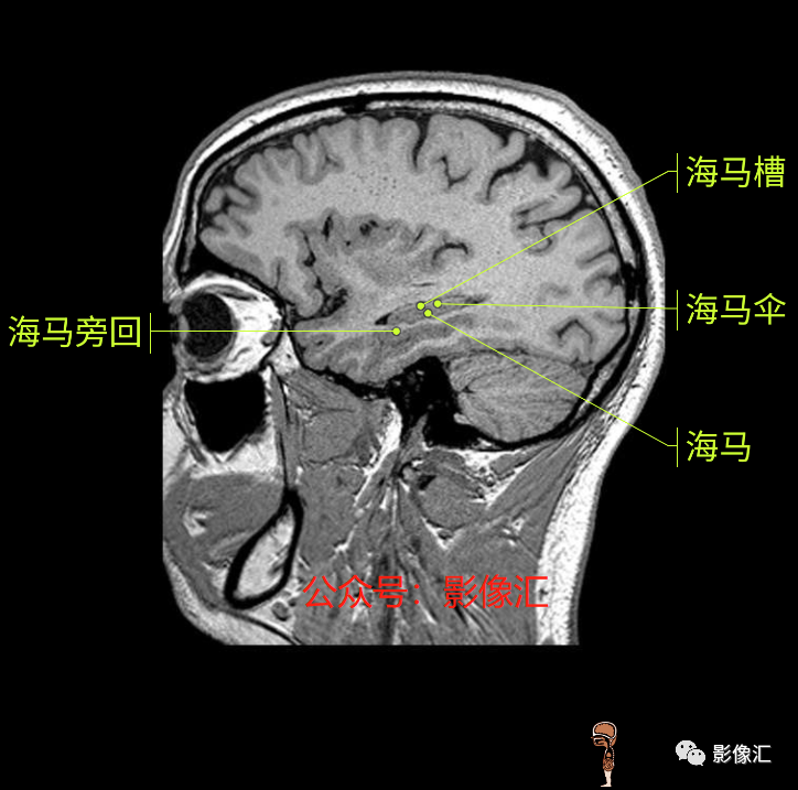 影像PPT - 脑边缘叶MR解剖标记-189